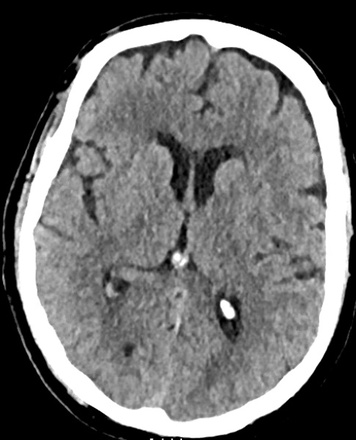 Double stenting technique thrombectomy and PTA treatment for intracranial stenosis - Figure 2