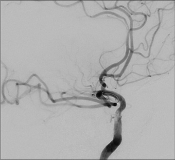 Double stenting technique thrombectomy and PTA treatment for intracranial stenosis - Figure 21