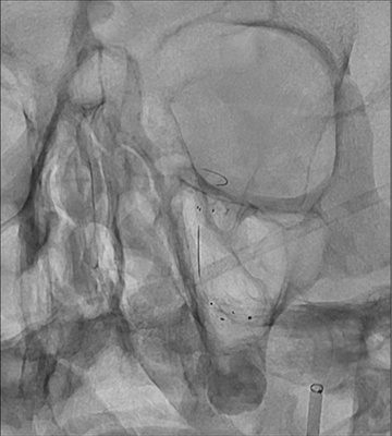 Double stenting technique thrombectomy and PTA treatment for intracranial stenosis - Figure 22