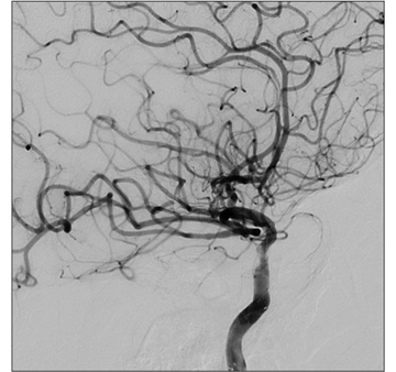Double stenting technique thrombectomy and PTA treatment for intracranial stenosis - Figure 24