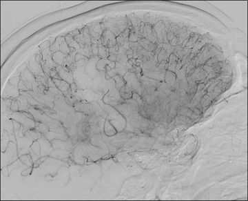 Double stenting technique thrombectomy and PTA treatment for intracranial stenosis - Figure 25