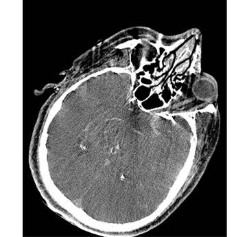 Double stenting technique thrombectomy and PTA treatment for intracranial stenosis - Figure 26