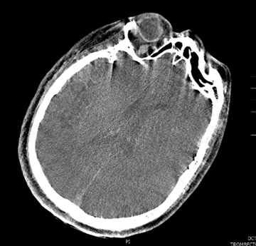 Double stenting technique thrombectomy and PTA treatment for intracranial stenosis - Figure 27