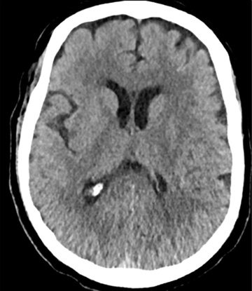 Double stenting technique thrombectomy and PTA treatment for intracranial stenosis - Figure 3