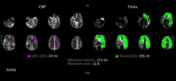 Double stenting technique thrombectomy and PTA treatment for intracranial stenosis - Figure 4