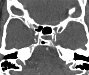 Double stenting technique thrombectomy and PTA treatment for intracranial stenosis - Figure 8