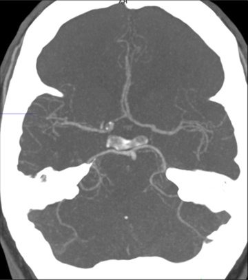 Double stenting technique thrombectomy and PTA treatment for intracranial stenosis - Figure 9
