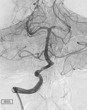 Thrombectomy #2