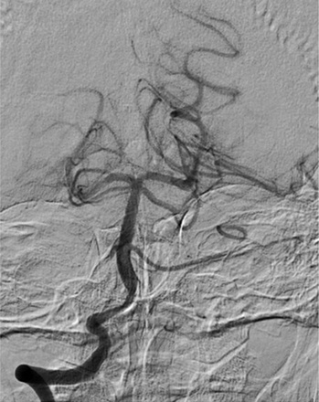 Thrombectomy #2