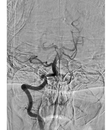 Thrombectomy #3