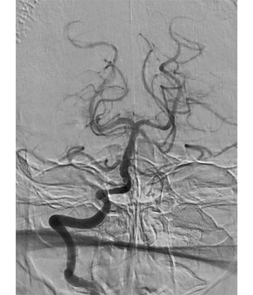 Thrombectomy #3
