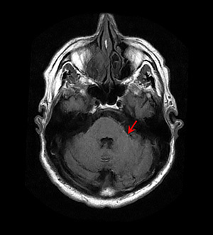 MRI - T1 FLAIR