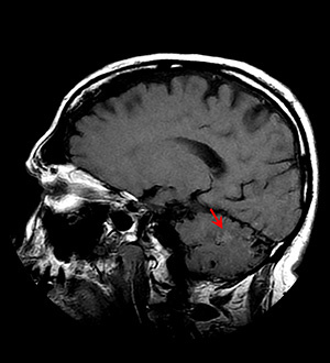 MRI - T1 FLAIR