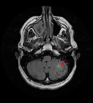 MRI - T2 FLAIR