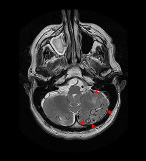 MRI - T2