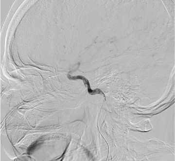 Microcatheter run