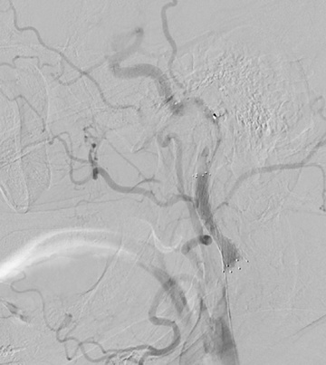 Protégé stent 10x40mm