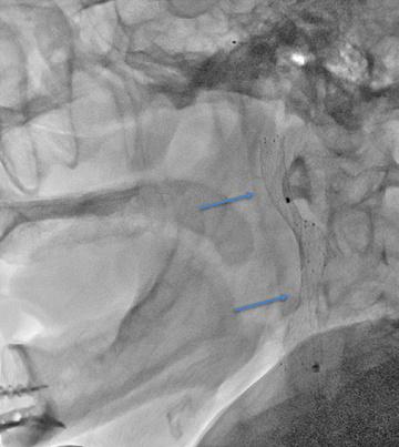 Telescoped another Protégé stent 10x40mm