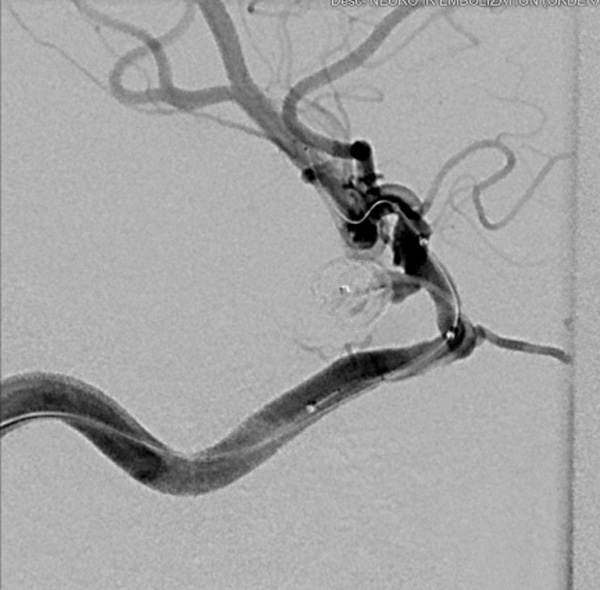 Target Tetra: PCOM Rupture embolization with contemporary coil - Figure 2