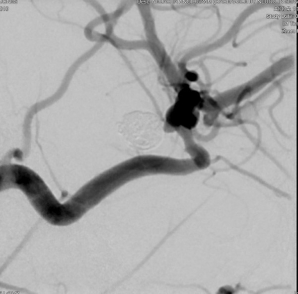 Target Tetra: PCOM Rupture embolization with contemporary coil - Figure 3