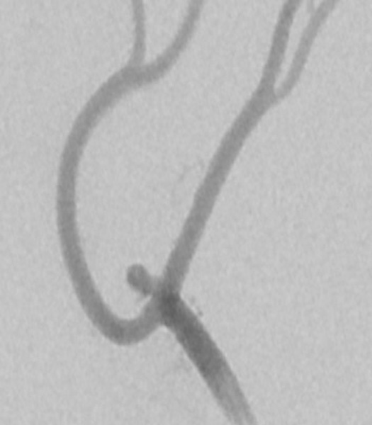 Target Tetra® Detachable Coil: Treatment of ruptured pericallosal anterior cerebral artery aneurysm - Figure 1