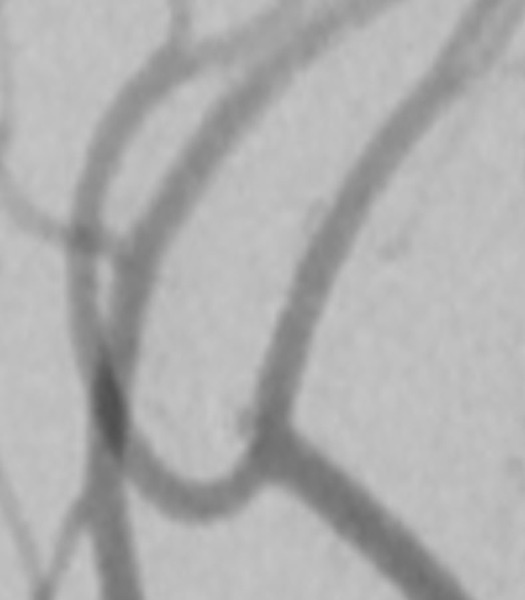 Target Tetra® Detachable Coil: Treatment of ruptured pericallosal anterior cerebral artery aneurysm - Figure 2