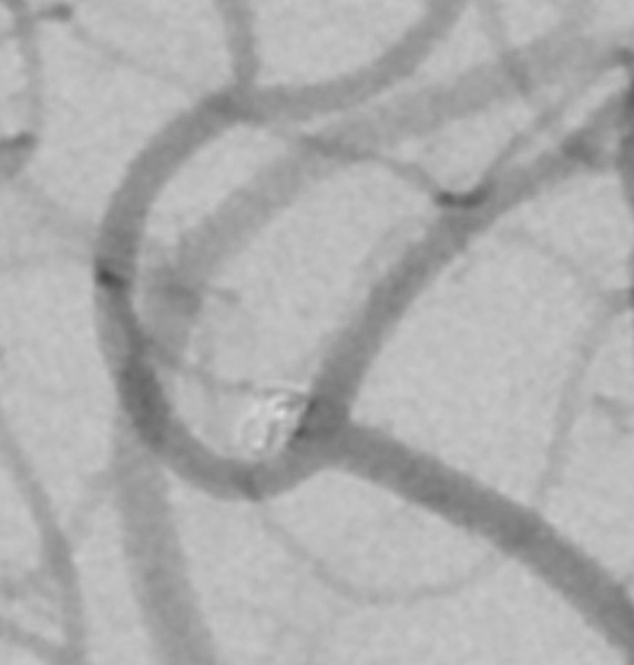 Target Tetra® Detachable Coil: Treatment of ruptured pericallosal anterior cerebral artery aneurysm - Figure 3