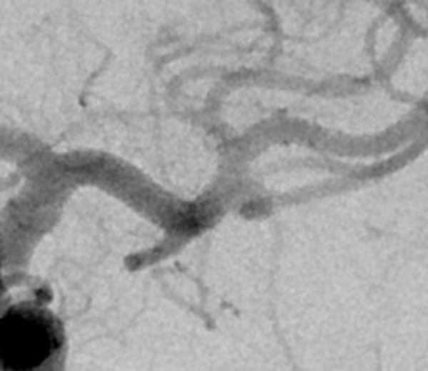 treatment-of-left-mca-aneurysm-figure1