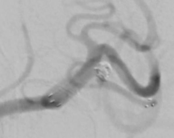 treatment-of-left-mca-aneurysm-figure2