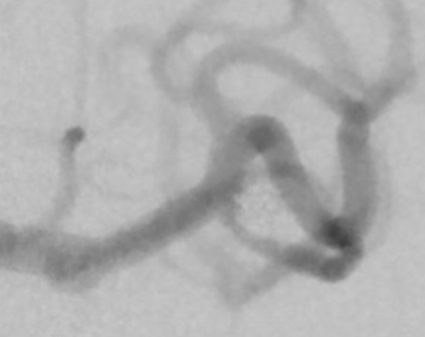 treatment-of-left-mca-aneurysm-figure3