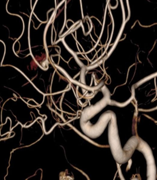 treatment-of-recanalized-pericallosal-artery-aneurysm-figure1