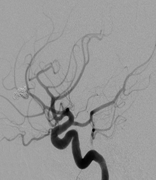 treatment-of-recanalized-pericallosal-artery-aneurysm-figure2