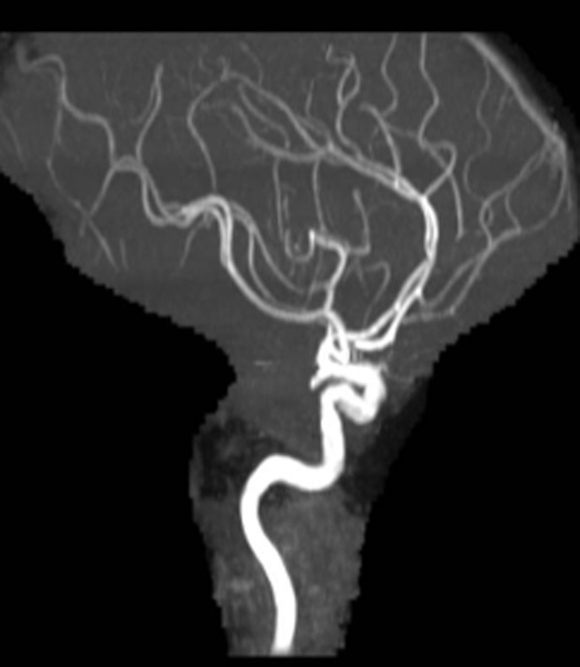 treatment-of-recanalized-pericallosal-artery-aneurysm-figure3
