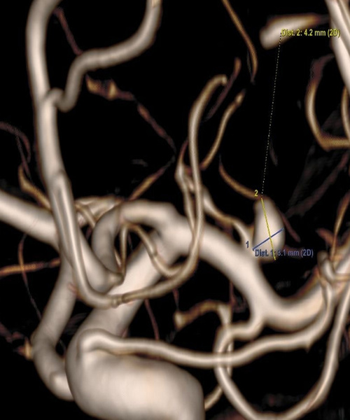 Treatment of ruptured MCA aneurysm - Figure 1