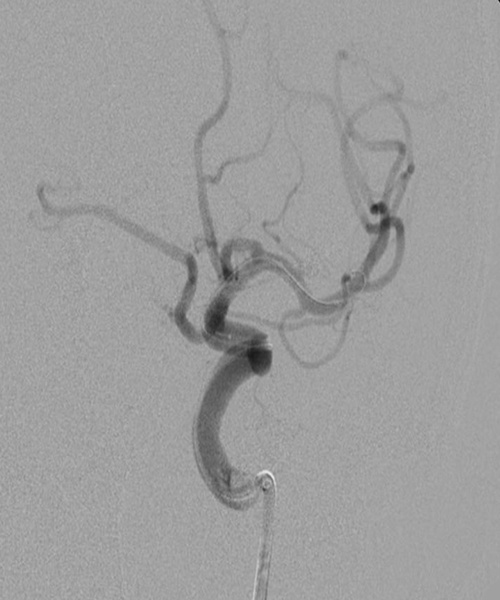 Treatment of ruptured MCA aneurysm - Figure 2
