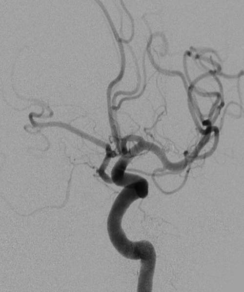 Treatment of ruptured MCA aneurysm - Figure 3