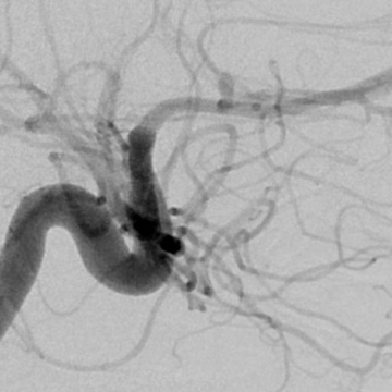 Versatile coil used to treat a ruptured right A1-A2 junction aneurysm - Figure 1