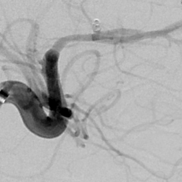 Versatile coil used to treat a ruptured right A1-A2 junction aneurysm - Figure 2