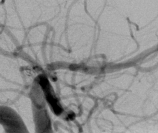 Versatile coil used to treat a ruptured right A1-A2 junction aneurysm - Figure 3