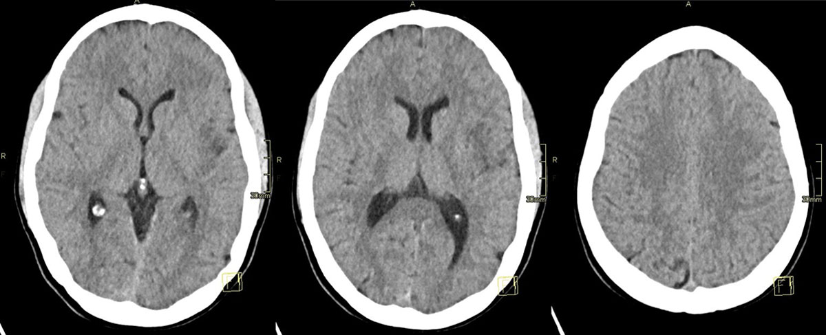 ica-m1-intracranial-dissection-evt-figure1
