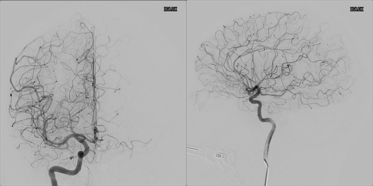ica-m1-intracranial-dissection-evt-figure10