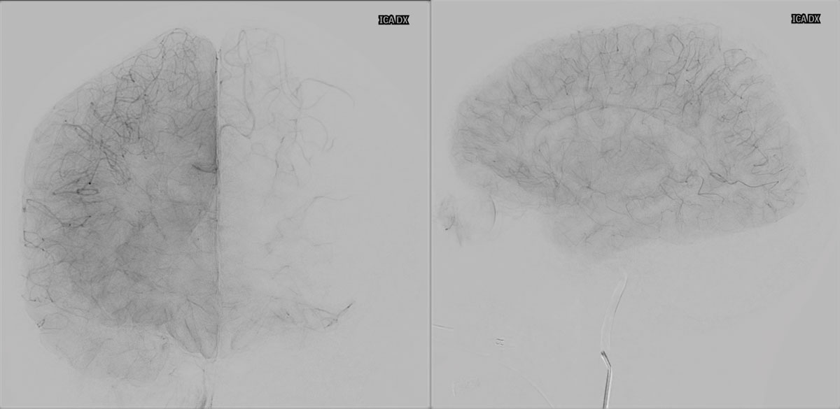 ica-m1-intracranial-dissection-evt-figure11