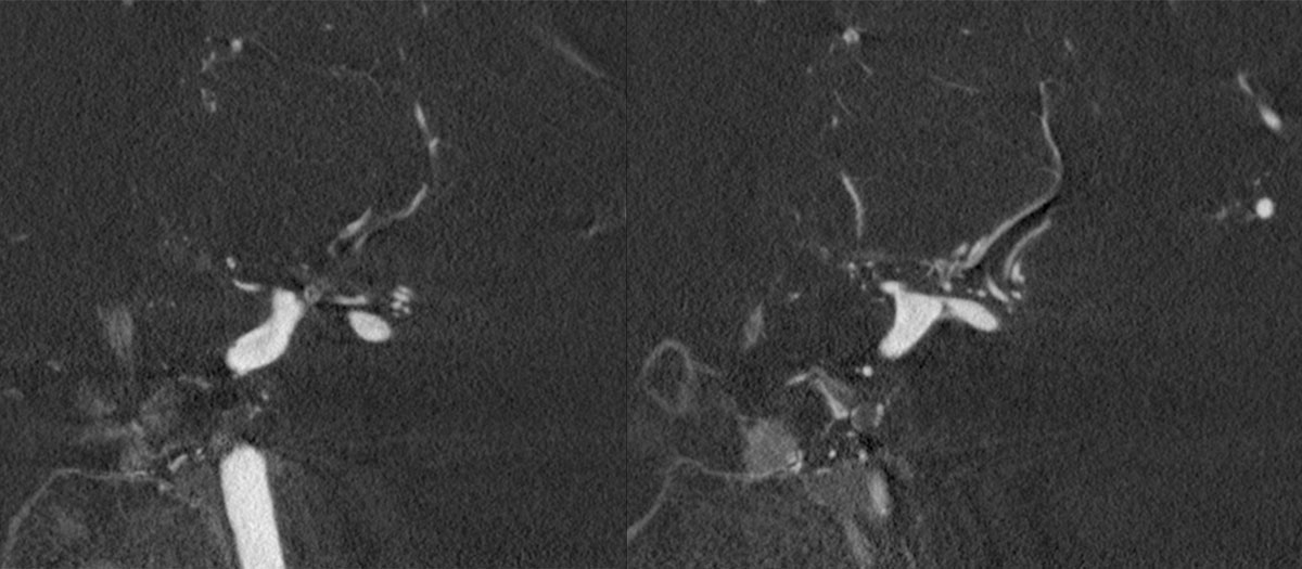 ica-m1-intracranial-dissection-evt-figure12