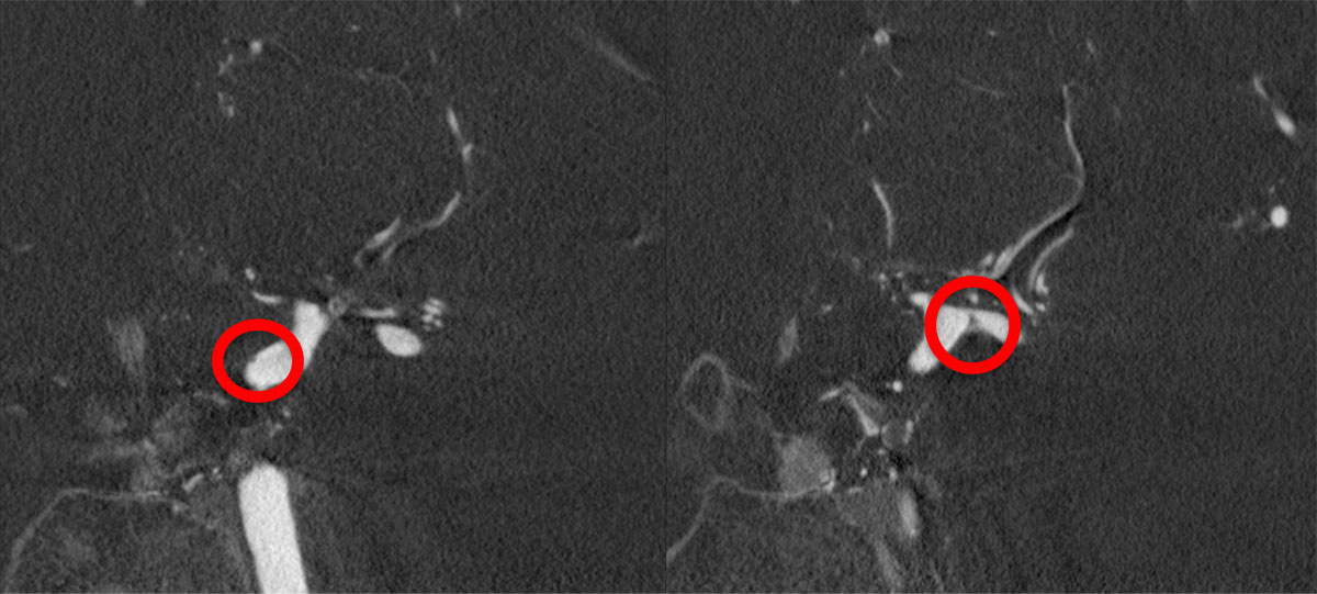 ica-m1-intracranial-dissection-evt-figure13