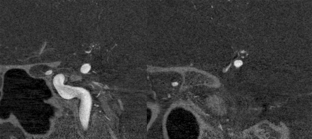 ica-m1-intracranial-dissection-evt-figure14