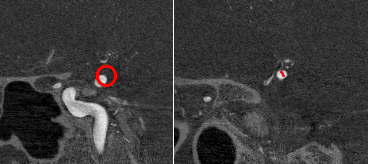 ica-m1-intracranial-dissection-evt-figure15