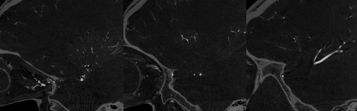ica-m1-intracranial-dissection-evt-figure16
