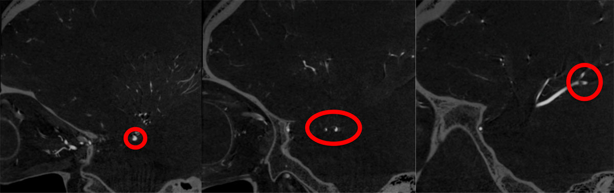 ica-m1-intracranial-dissection-evt-figure17