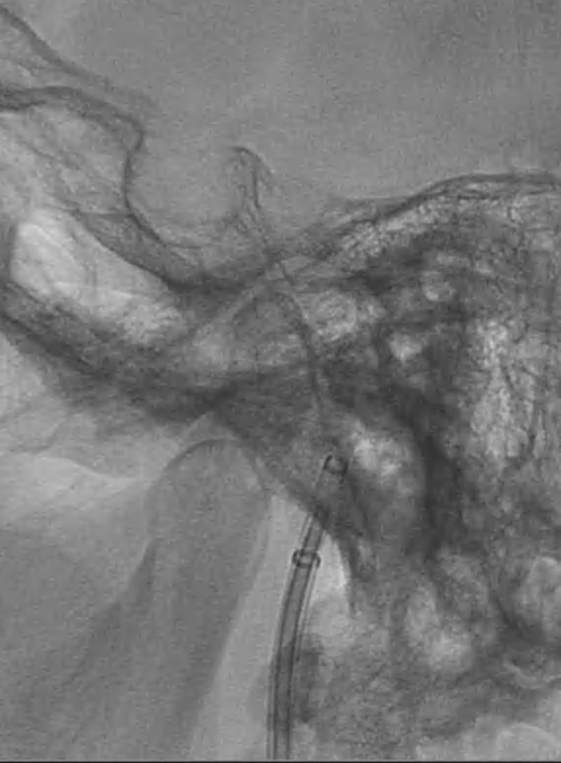 ica-m1-intracranial-dissection-evt-figure18