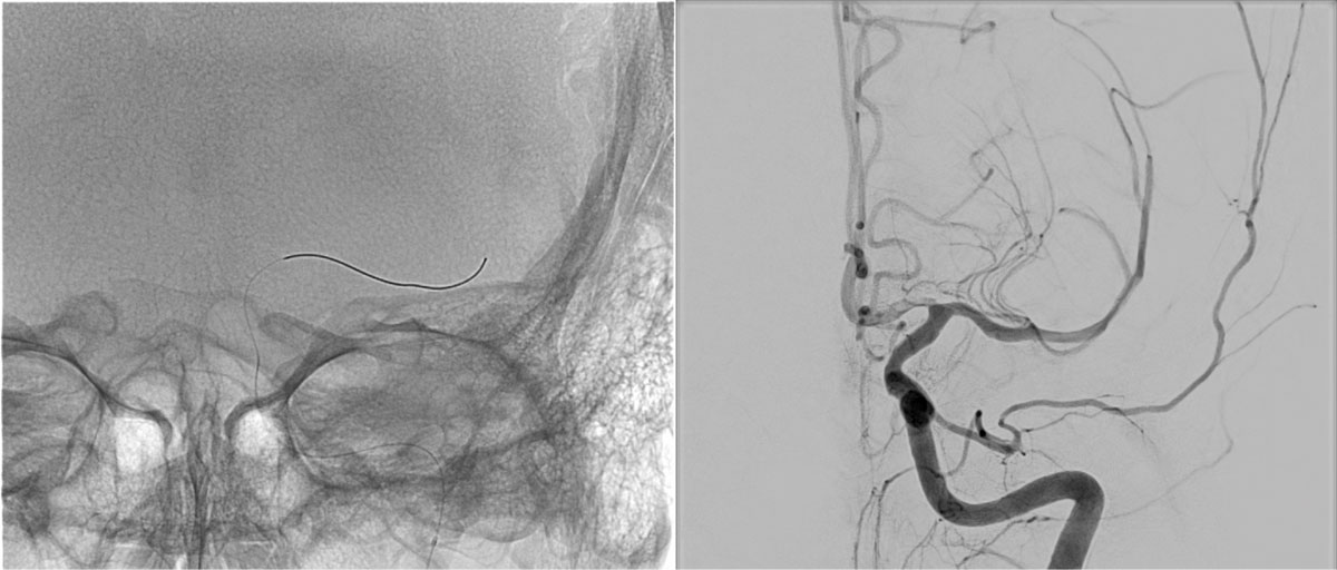 ica-m1-intracranial-dissection-evt-figure19
